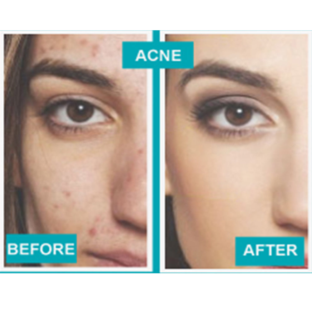 Diamond Secret Microdermabrasion System
